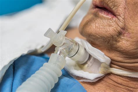 Tracheostomy .
